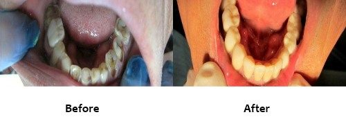 Crowns Before and After