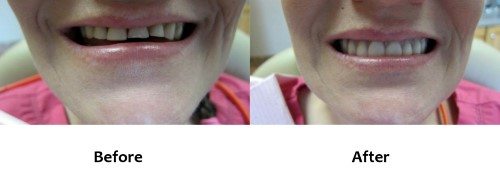Denture Before and After