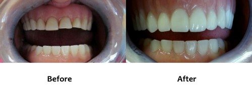 Denture Before and After