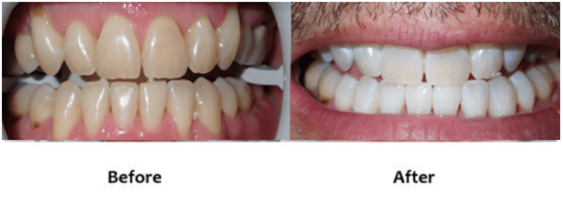 Zoom® Teeth Whitening Before and After
