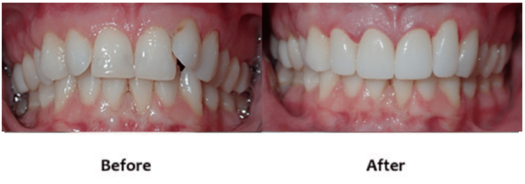 Crowns Before and After