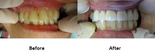 Veneers Before and After
