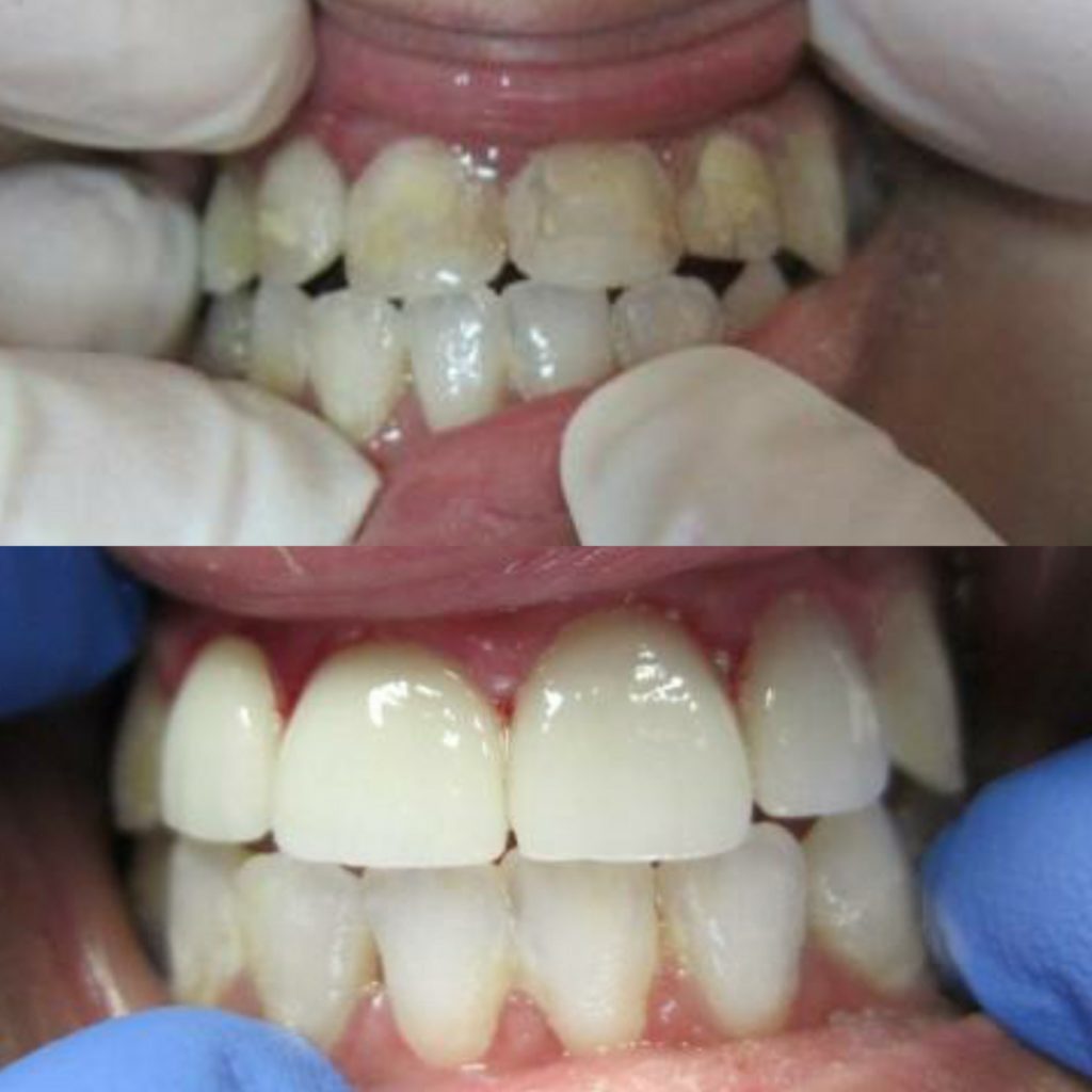 Anterior Crowns Before and After