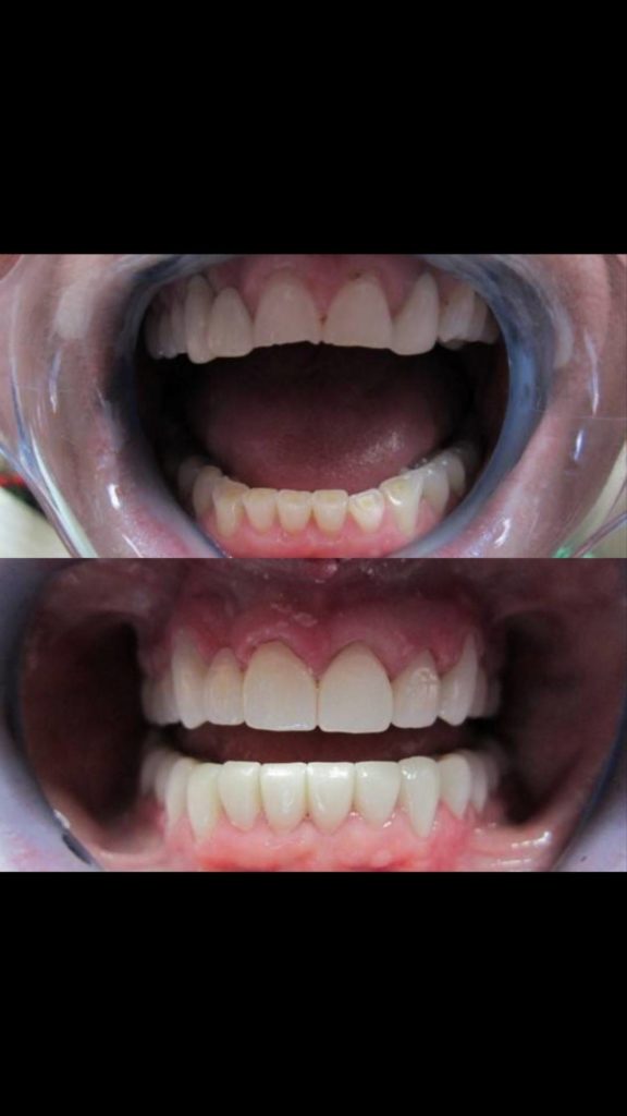 Full Mouth Crowns Before and After