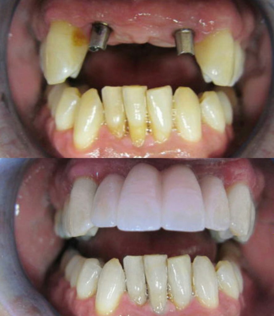 Implants Before and After