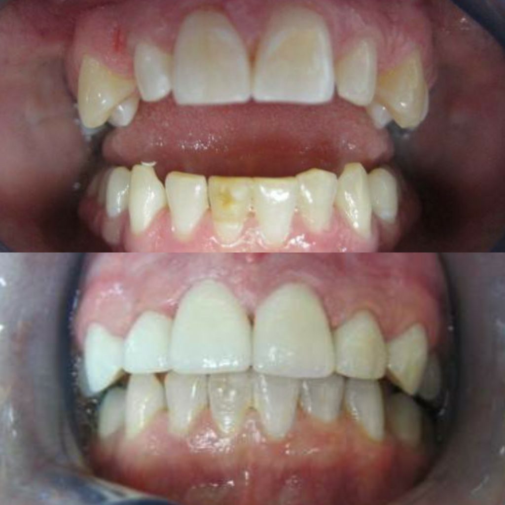 Veneers Before and After