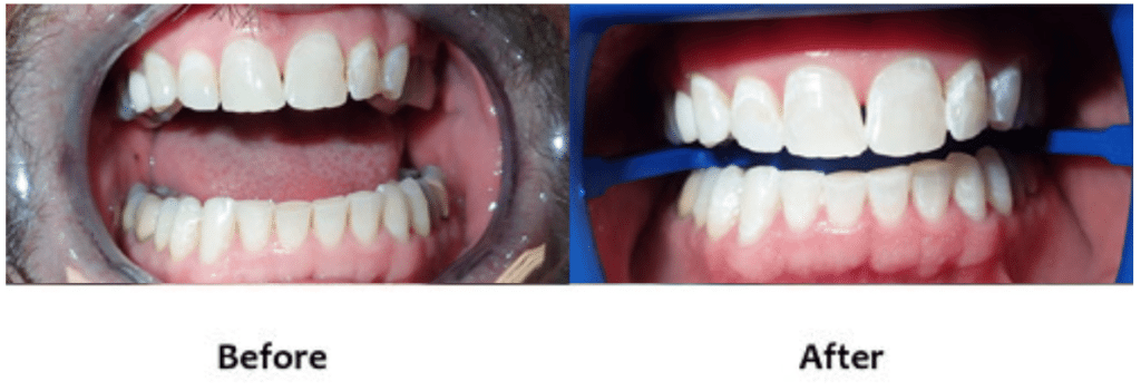 Zoom® Teeth Whitening Before and After
