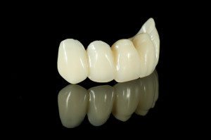 Example picture of what dental bridges would look like