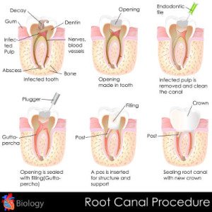 Diagram of the root canal treatment procedure at Torghele and Schmid Dental in Ogden, UT