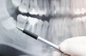 x-ray of clients tooth taken before tooth extraction