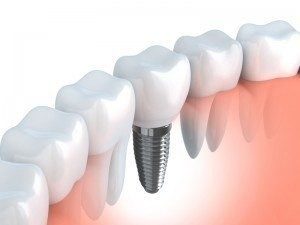 Diagram of a dental implant with post, abutment, and crown shown during consultation at Torghele and Schmid Dental