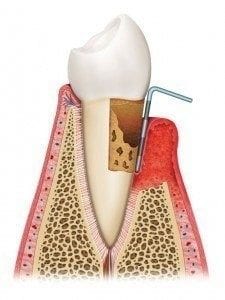 gum disease treatment ogden ut