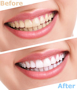 Teeth Whitening Service – Before & After