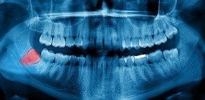 X-ray showing a wisdom tooth before extraction