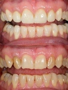 client-picture-of-before-and-after dental bonding procedure