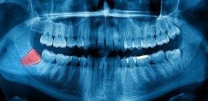 Panoramic x-ray highlighting 1 of the 4 wisdom teeth to show why it has to be extracted.